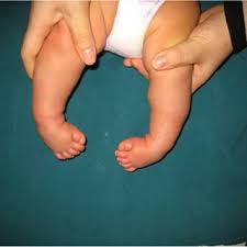 Bilateral Clubfoot
