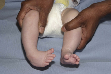 Unilateral Clubfoot